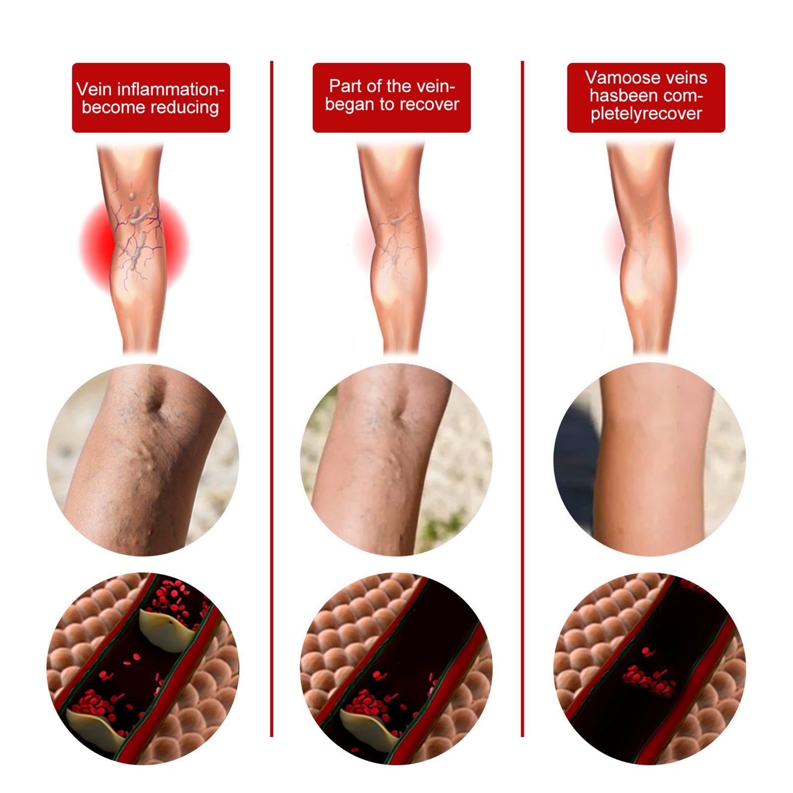 Intravenous Massage Spray For Varicose Veins Relief And Earthworm Leg Blood Vessel Bulge Pain Spray